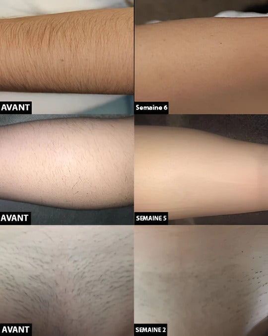 Light-Based Hair Removal Device with Skin-Contact Activation and Rechargeable Design