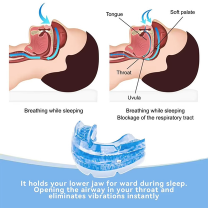 Oral Jaw Advancement Device with Multi-Position Adjustment for Sleep Apnea